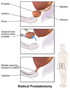 Robotic Radical Prostatectomy